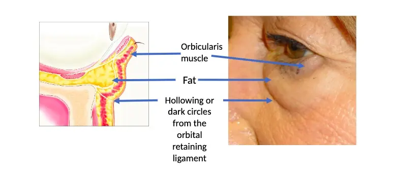 結構性黑眼圈